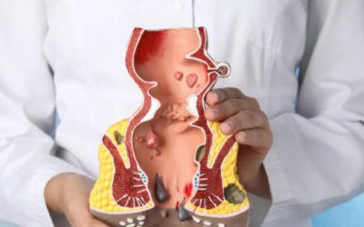 Can Hemorrhoids Cause Cancer?