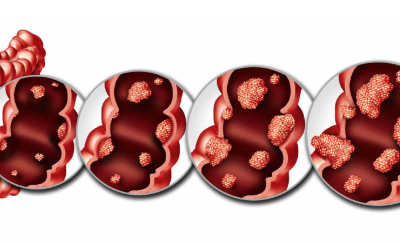 Survival Rate for Colon Cancer in India