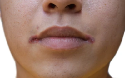 What Causes Oral Cancer?