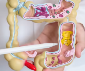 What Foods Cause Colon Cancer