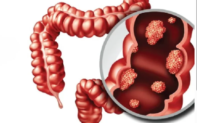 What Is Colon Cancer and How Is It Treated?