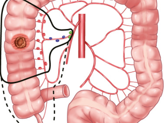 What Is D3 Resection for Colon Cancer?
