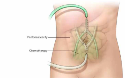 What Is HIPEC Treatment for Stage 4 Cancer?