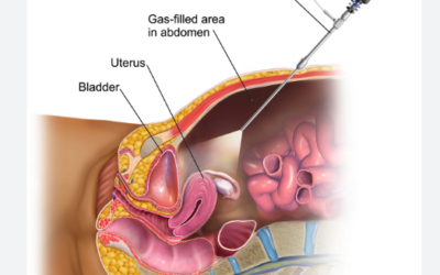 What Is Laparoscopic Surgery Explained Simply?