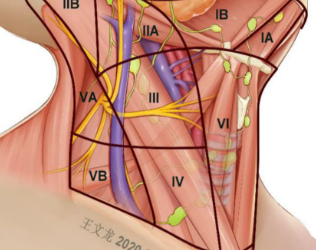 What Is Neck Dissection Surgery for Cancer?