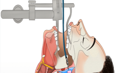 What Is TORS Trans Oral Robotic Surgery?