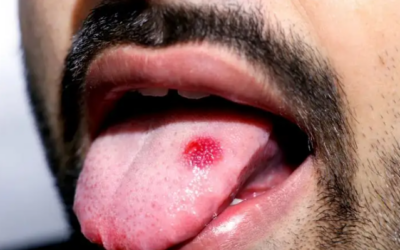 What Is Tongue Cancer and How Is It Treated?