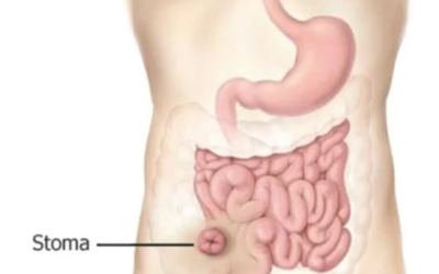 What Is a Permanent Stoma and How to Avoid It?