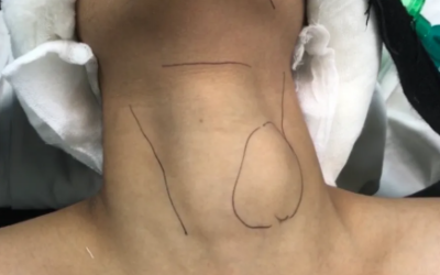 Where Can I Get RABIT Thyroid Surgery in India?