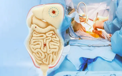 Where to Get HIPEC Treatment in Bangalore India?