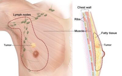 Can Men Get Breast Cancer: Risks, Signs and Treatment