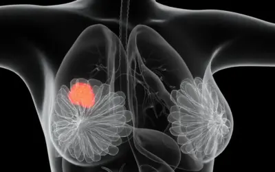 What Is a Second Opinion in Cancer Diagnosis ?