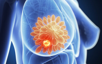 What Are the Stages of Breast Cancer Explained Simply ?