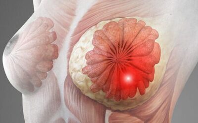 What Is Inflammatory Breast Cancer ?