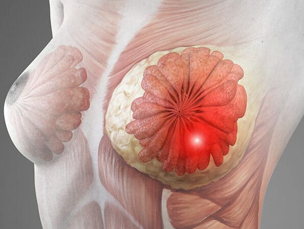 What Is Inflammatory Breast Cancer