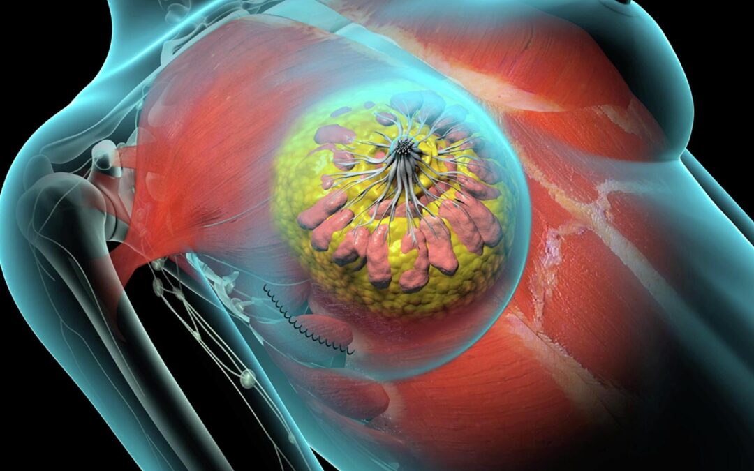 Advanced Breast Cancer Surgery Cost in India vs Abroad