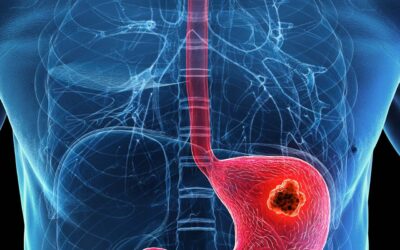 Early Signs of Stomach Cancer Most People Miss