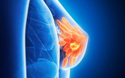 HER2 vs Triple Negative Breast Cancer: How Do Outcomes Differ