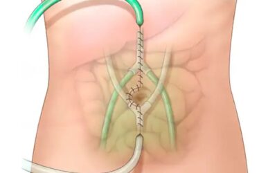 What Is HIPEC and How Is It Used Against Cancer ?