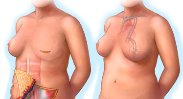 How Long Does Breast Cancer Surgery Take?