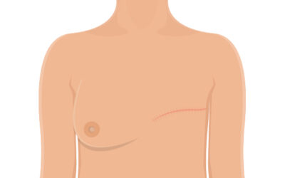 Radiation After Mastectomy vs No Radiation: When Is It Recommended