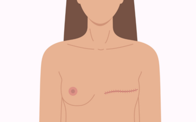 What Is the Recovery Time After Mastectomy Surgery ?