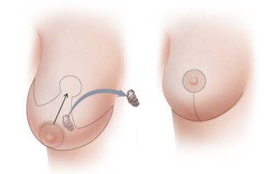 What Is Oncoplastic Breast Surgery ?
