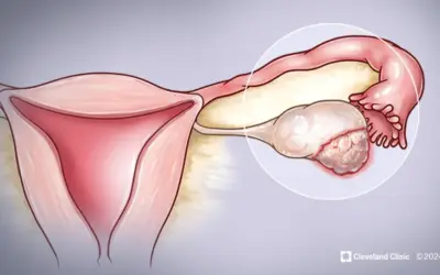 How Is Silent Ovarian Cancer Detected?