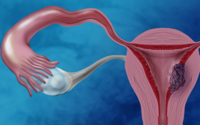 What Is Cytoreductive Surgery in Cancer Treatment?