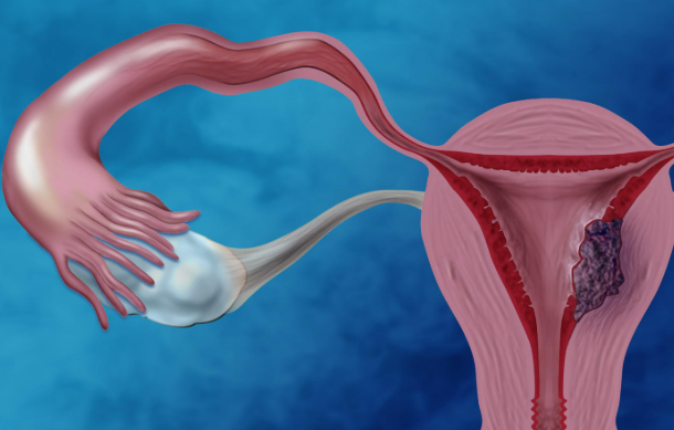Medical illustration of the female reproductive system: a fallopian tube with an ovary on the left and a uterus on the right showing a purple growth inside the uterine cavity.