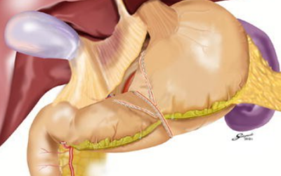 What Is Laparoscopic Cancer Surgery?