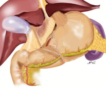 Anatomical illustration of the upper digestive system showing a surgically stapled stomach with visible sutures and nearby organs