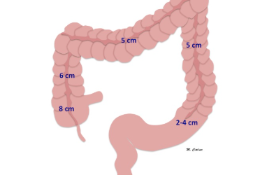 What Is Multivisceral Resection in Cancer Surgery?