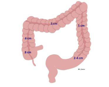 Diagram of the large intestine with labeled segment lengths (6 cm, 8 cm, 5 cm, 5 cm, 2–4 cm) in a pink schematic illustration.