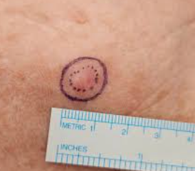  What Is a Surgical Margin in Cancer Surgery?