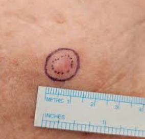 Close-up of a circular skin mark with a dashed border and red center, measured against a ruler.