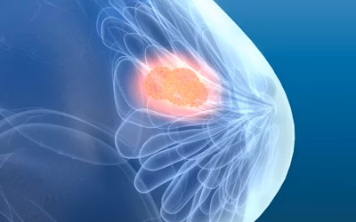 What Is Breast Cancer and How Is It Diagnosed in India ?