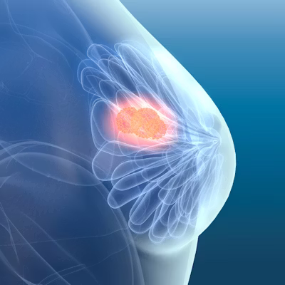 What Is Breast Cancer and How Is It Diagnosed in India | Dr. Sandeep Nayak