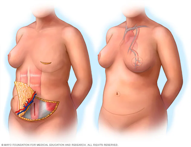 Educational illustration of a female torso showing breast reconstruction (TRAM flap): left panel reveals abdominal tissue and muscle moved to the chest, right panel shows the reconstructed breast with vascular connections.