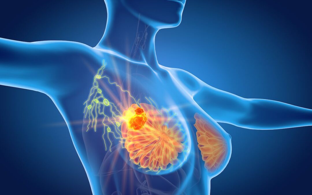 What Is Sentinel Lymph Node Biopsy in Breast Cancer