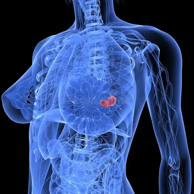 Can Breast Cancer Come Back After Surgery
