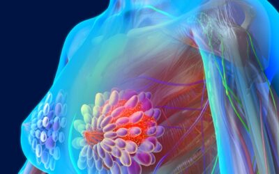 Neoadjuvant Chemotherapy in Breast Cancer