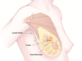 What Is Breast Conserving Surgery and Who Qualifies ?