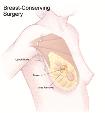 Illustration of a woman's breast during breast-conserving surgery showing a labeled tumor, surrounding tissue labeled 'Area Removed', and a nearby lymph node.