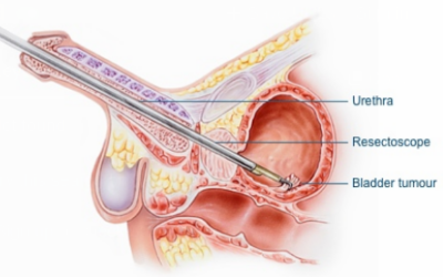 Cancer Surgery: What It Is and When It’s Needed