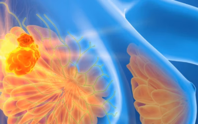 Breast Cancer Surgery Abroad vs India: Is Quality Different