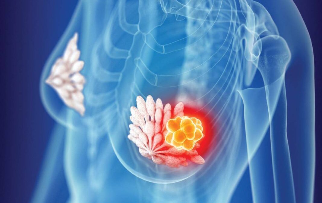 Early Stage vs Locally Advanced Breast Cancer: How Surgery Changes