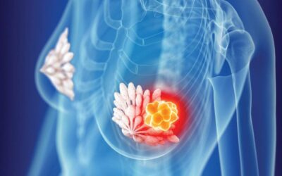 Early Stage vs Locally Advanced Breast Cancer: How Surgery Changes