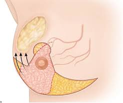Oncoplastic vs Standard Lumpectomy: What Is the Difference