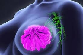 Breast Cancer at 25 vs 50: How Does Age Affect Surgery?